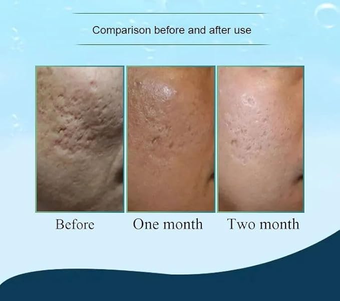 Hydra Needle 20 Titanium Serum Applicator Tools Reusable-VivaGrace Women