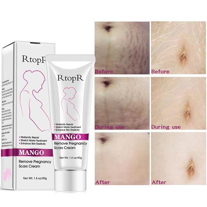 Mango Stretch Marks and Scar Cream, Stretch Marks and Scar Removal Cream for Pregnancy, Stretch Marks Scar Belly Creams for Wrinkles, Obesity Fat Stretch Mark Moisturizing, Remove Marks (40g)-VivaGrace Women