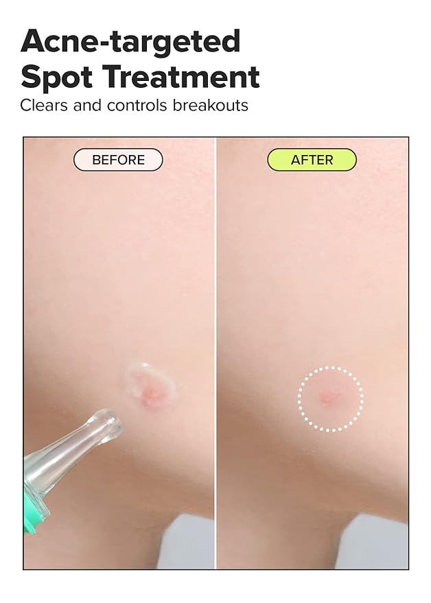 I DEW CARE Acne Gel Treatment - Fix My Zit | with 0.55% Salicylic Acid, Spot Treatment, Blemishes & Zits, Pimple Control, Clears Breakouts, for Sensitive Skin, Soothing, 0.67 FL Oz
