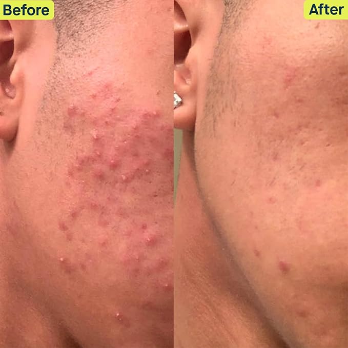 SLMD Skincare by Dr. Pimple Popper - 30-Day Acne System - 4-pc Kit - 3 Steps, 2x per Day Full Routine to Treat and Prevent All Stages of Acne-VivaGrace Women