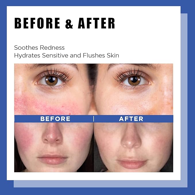 It'S SKIN LI Calming Skincare Set - Soothing Toner Pads, Ampoule Serum, Moisture Cream – Redness & Acne Relief with Licorice Extract & Guaiazulene – for Clear Skin-VivaGrace Women