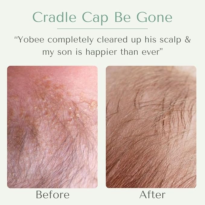 Yobee Ultra Gentle Soothing Scalp Mask - Dry Scalp Treatment Hair Mask Safe For Sensitive Baby Skin - Probiotic Infused - For Sensitive Scalp & Cradle Cap - For Babies, 4 fl oz-VivaGrace Women
