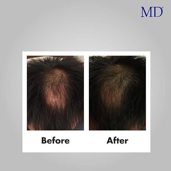 MD Scalp Essential Serum | Hair Growth Treatment Formula for Dandruff, Hair Loss, Scalp-Itch, thinning, | Promote Hair Regrowth, DHT Blocking | 2 Fl Oz 2 Months Supply