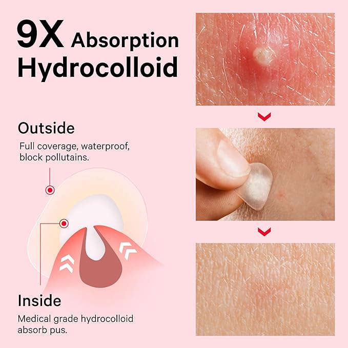 Sosky Pimple Patches for Face, FSA HSA Eligible Invisible Hydrocolloid Acne Patches, Zit Sticker for Face and Skin, Pimple Sticker for Covering Zits, Blemishes with Salicylic Acid 96 Count