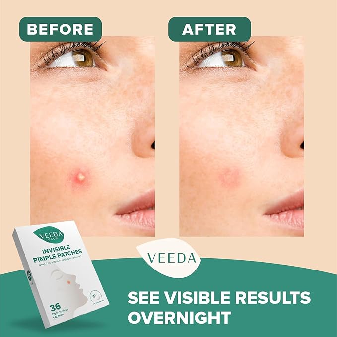 Veeda Glow Pimple Patches – Hydrocolloid Acne Stickers for Fast Healing, Invisible & Non-Irritating Zit Covers, Blemish Spot Treatment, 36 Count