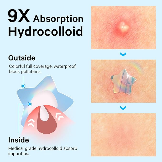 Sosky Hologram Pimple Patches for Face, Hydrocolloid Acne Patches with Salicylic Acid, Cute Star Zit Stickers,Colorful Blemish Covers,48 Count Blue Star Butterfly