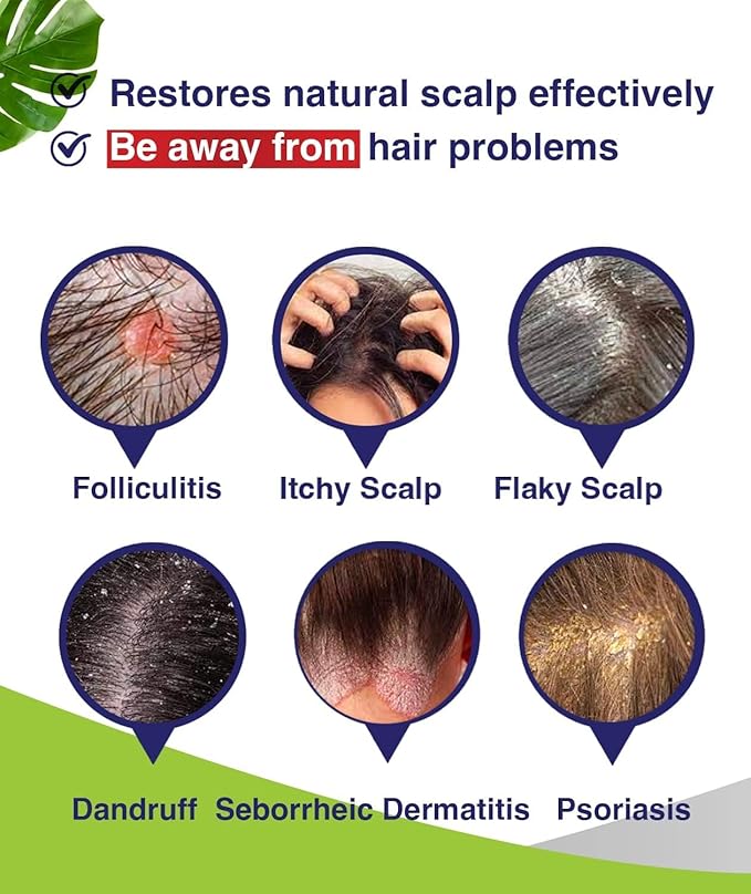 Anti-Fungal Shampoo for Folliculitis, Seborrheic Dermatitis, Scalp Psoriasis - Relieves Itchy & Dry Scalp-VivaGrace Women