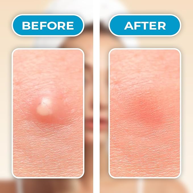 Hydrocolloid Pimple Patches for Face - 36 Invisible Patches - Clear Acne Patches with Tea Tree Oil for Rapid Protection - Invisible Pimple Patches with Zero Residue for All Day Confidence
