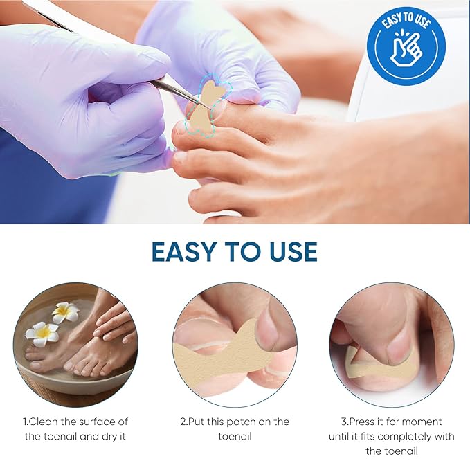 Ingrown Toenail Treatment, 60Pcs Ingrown Toenail Corrector Strips, Ingrown Toenail Removal Kit with File and Lifter, 60Pcs-VivaGrace Women