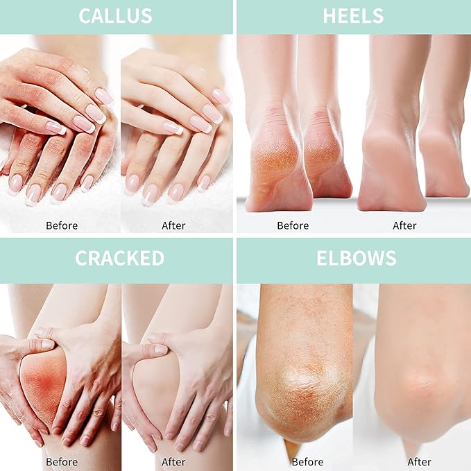 2 Packs Urea Cream 40% Plus 2% Salicylic Acid 5.30 oz || Foot Cream Maximum Strength with Hyaluronic Acid, Tea Tree, and Aloe Vera for Deep Moisturizes, Callus Remover and Soften