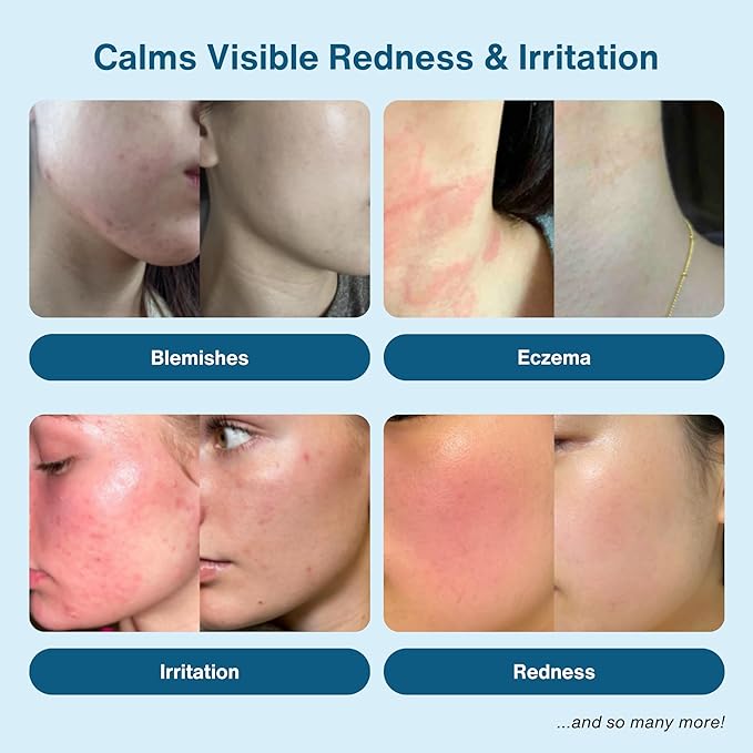 Hypochlorous Acid Spray – Eyelid Cleanser, HOCl Face & Skin Mist for Acne, Eczema & Irritation – Multi-Purpose Skin Repair – Post-Workout, Scalp & Sensitive Skin, Travel Size - 2 oz-VivaGrace Women