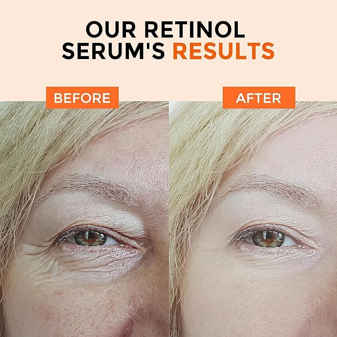 Face Serum Set – Retinol Serum & Hyaluronic Acid for Face – Anti Aging Skin Care Set for Women – Firm, Wrinkle Smoothing-VivaGrace Women