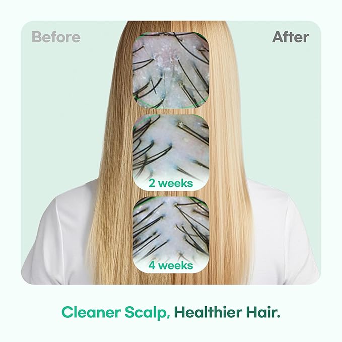TS GD Shampoo for Teens | Korean Anti-Dandruff Shampoo for Oily & Itchy Scalp | Fruity Allergy-Free Scent | Sulfate-Free Gentle Hair Care (14.1 Oz)-VivaGrace Women