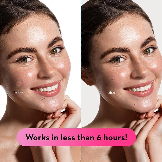 LE GUSHE Pimple Patches for Face (66 Dots) - Hydrocolloid Acne Patches for Face - Invisible Zit Stickers - Flatten Spots in 6-8 Hrs