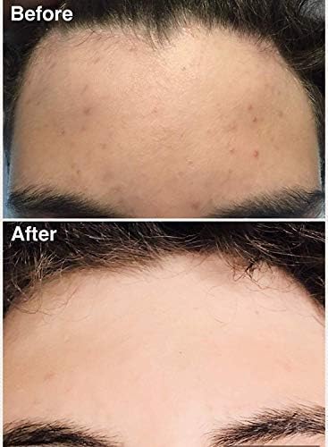 Teenology Shampoo for Teens - Avoid Forehead and Body Acne - No Sulfates or Parabens, Noncomedogenic, Natural Botanical Extracts, 16 oz. (Fresh Papaya)-VivaGrace Women