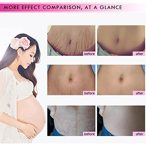 Mango Stretch Marks and Scar Cream, Stretch Marks and Scar Removal Cream for Pregnancy, Stretch Marks Scar Belly Creams for Wrinkles, Obesity Fat Stretch Mark Moisturizing, Remove Marks (40g)-VivaGrace Women