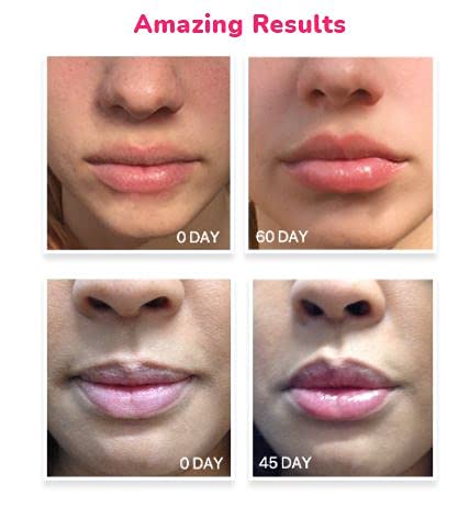 LifeCell Lip Plumping Treatment-VivaGrace Women
