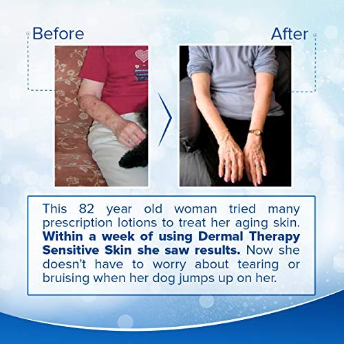 Dermal Therapy Sensitive Skin Lotion - Calming, Non-Irritating Lotion with 15% Allantoin, 10% Shea Butter, Vitamin E - Soothing Relief for Dry, Itchy, Eczema-Prone Skin - 8 fl oz / 240 ml-VivaGrace Women