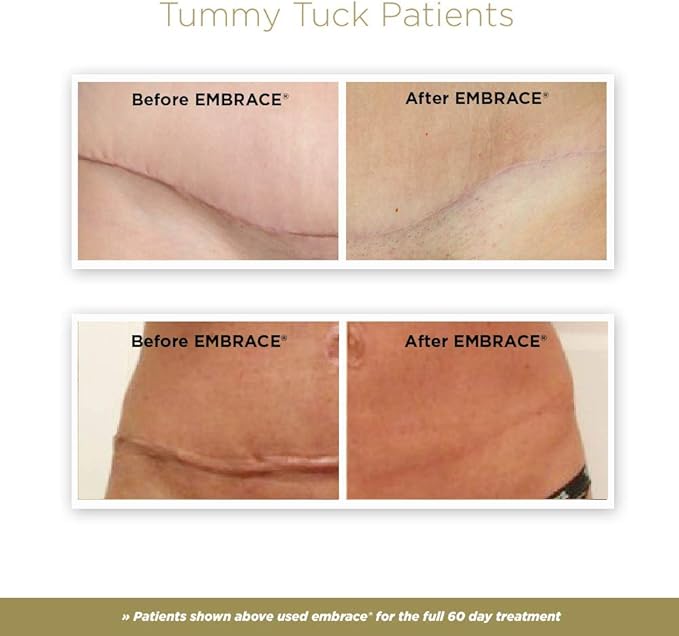 Embrace Active Scar Defense for New Tummy Tuck Scars, FDA-Cleared Extra-Large Silicone Scar Sheets, 30 Day Supply-VivaGrace Women