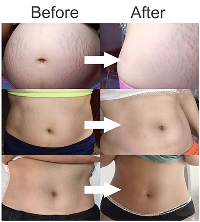 Stretch Mark Cream 120g/4 oz Stretch Marks Lotion Pregnancy Creams, Belly Butter Pregnant Women Stretch Mark Removal Treatment, Maternity Skin Care Moisturizer Scar Wrinkle Prevention-VivaGrace Women