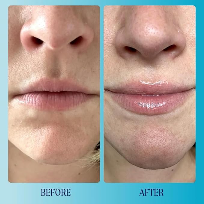 Kinship Supermelt Lip Plumping Jelly Mask - Moisturizing Daily Lip Treatment + Hyaluronic Acid - Hydrating + Exfoliating Lip Gloss - Soft, Smooth, Plump - Quick Melting Balm - Soothe Dry Lips (.3 oz)-VivaGrace Women