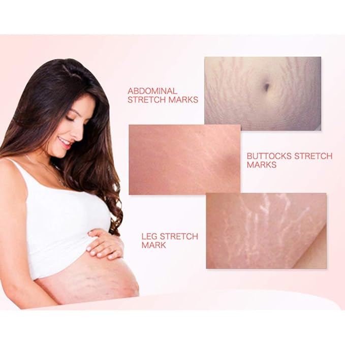 AICHUN BEAUTY Pregnancy Cream Streach Mark Remover Scars Repair Cellulites Lotion Cream 150ml-VivaGrace Women