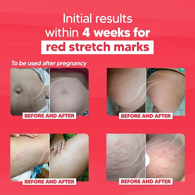 Cicatrissim Red For Removal of Red and Purple Stretch Marks - Innovative Formula With Pure and Powerful Natural Ingredients From Brazilian Flora - For All Skin Types.-VivaGrace Women
