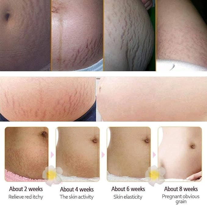 RtopR Mango Stretch Marks and Scar Cream -Stretch Marks and Scar Removal Cream for Pregnancy - Best Body Moisturizer-40g-VivaGrace Women