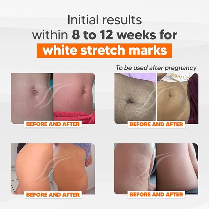 Cicatrissim Deep Stretch Mark Removal Cream - Innovative Formula With Pure and Powerful Natural Ingredients From Brazilian Flora - For All Stretch Marks & Skin Types.-VivaGrace Women