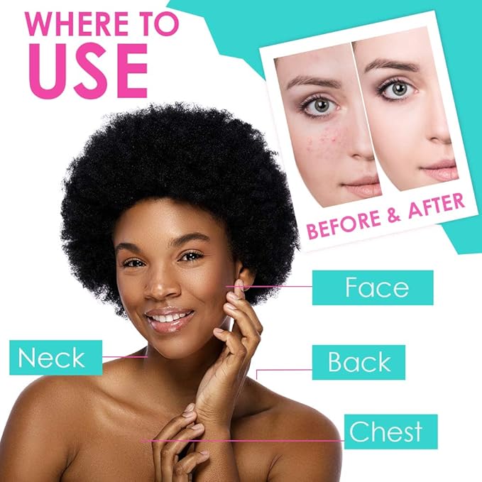 Bye Bye Blemish Acne Drying Lotion, Reduce Pimples Overnight, On-the-Spot Pimple Treatment, Beauty Skincare Essential - 1oz. (3 Pack)-VivaGrace Women