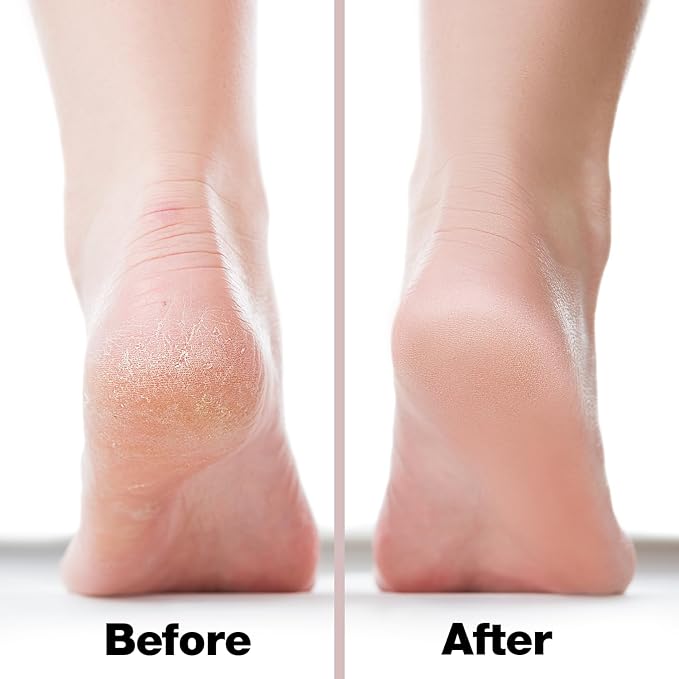 Probelle Double Sided Multidirectional Nickel Foot File Callus Remover - Immediately Reduces calluses and Corns to Powder for Instant Results, Safe Tool (Pink)-VivaGrace Women