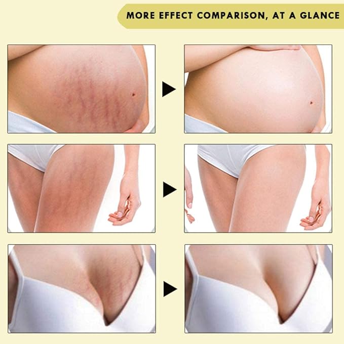 Rose Remove Stretch Marks Cream for Pregnancy Scar Removal Cream Natural Plant Essence Formula Prevention Remove Stretch Mark Old Scars Body Moisturizer 40g-VivaGrace Women