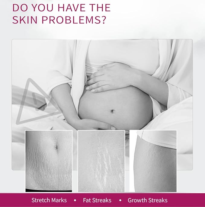 Stretch Mark Removal Cream, Obesity Stretch Mark Moisturizer, Postpartum Repair Stretch Mark Cream, Abdominal Stretch Mark Cream, Remove Marks (2 PCS)-VivaGrace Women