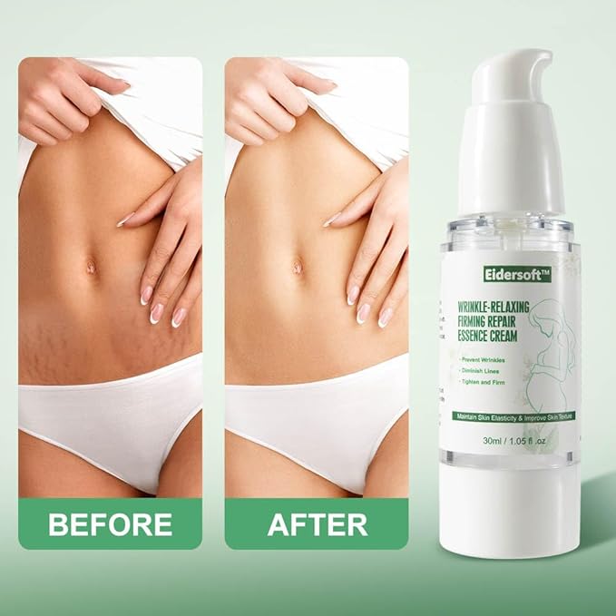 Wrinkle-Relaxing Firming Repair Essence Cream - Removes Maternity Stretch Marks, Prevents Wrinkles & Fine Lines, Nourishes & Rejuvenates Skin with Safe, Natural Formula-VivaGrace Women