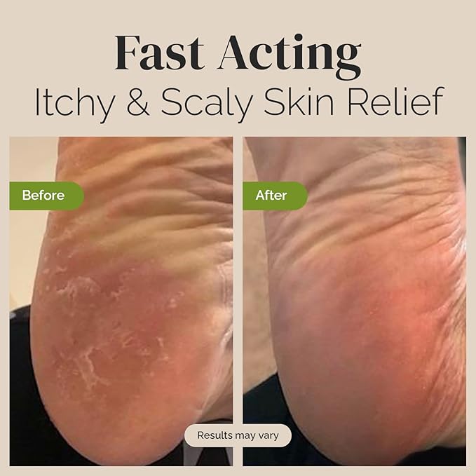 Tea Tree Oil Balm, Extra Strength, Pair Well with Jock Itch Cream, Spray, Athletes Foot, Ringworm Cream for Human, Rash Cream, Fast Acting for Dry, Itchy Skin, Plant Powered Wonder Balm-VivaGrace Women