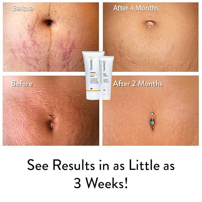 TriLASTIN-SR Intensive Stretch Mark Cream Bundle with Hydro-Thermal Accelerator (5.5 & 3 oz) | Fast-Acting Stretch Marks Cream with Absorption Enhancing Serum | Hypoallergenic & Paraben-free-VivaGrace Women
