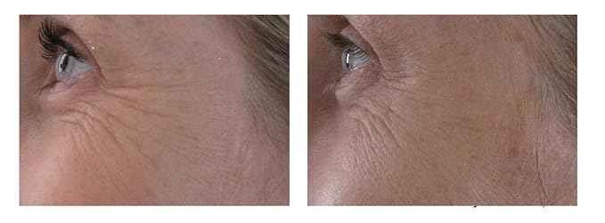 Airelle Age-Defying Eye and Lip Treatment | Anti Aging, Helps Reduce Wrinkles, Fine Lines | Dermatologist Recommended | Hyaluronic Acid, Berrimatrix | Natural Ingredients | .3 Fl Oz-VivaGrace Women