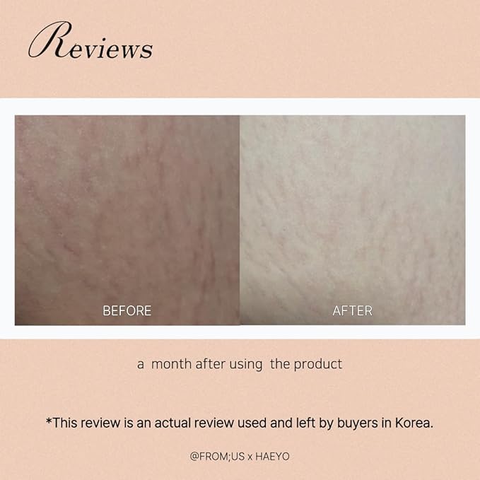 [Antley] Stretch Care Cream | Antley Ointment Gel-type | Medical Device Effective for Pregnant Dieters Adolescents (Gel Type), White-VivaGrace Women