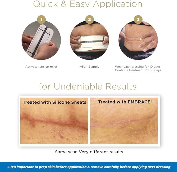 Embrace Active Scar Defense for New Scars, FDA-Cleared Medical-Grade Silicone Scar Sheets for Hypertrophic & Keloid Scar Treatment, 4.7 Inch, Large, 30-Day Supply-VivaGrace Women