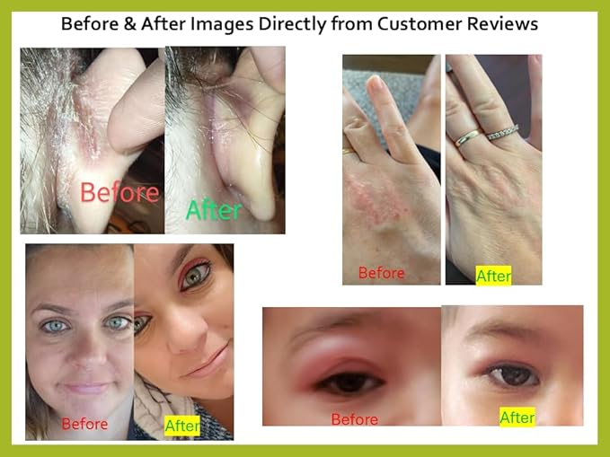 Tea Tree Oil Balm -100% All Natural | Great Cream for Soothing Irritations like Rashes, Insect Bites, Folliculitis, Acne, Itches, Dry Heels, Cuticles, Saddle Sores and more!-VivaGrace Women