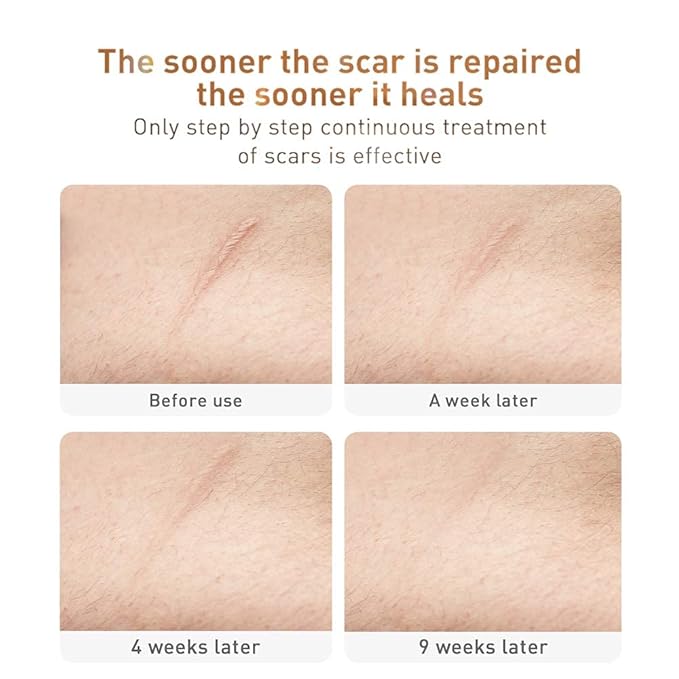 Acne Scar Removal Cream Stretch Marks Face Skin Cream Shrink Pores Gel-Fade Scar Marks Acne Skin Care (Packaging Upgrade) VeniCare-VivaGrace Women