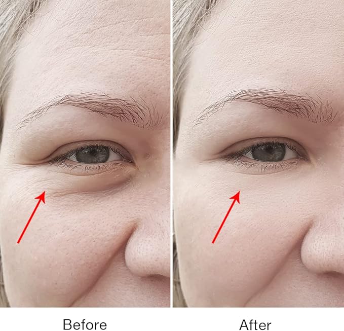 Puffy Eyes Treatment | Eye Puffiness | Eye Bags | Crows Feet | Fine Line Reducing - TS-Lifter Technology(Minor Stings) + Radio Frequency - 2 in 1 Professional RF Eye Anti Aging Device-VivaGrace Women