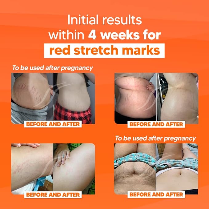 Cicatrissim Deep Stretch Mark Removal Cream - Innovative Formula With Pure and Powerful Natural Ingredients From Brazilian Flora - For All Stretch Marks & Skin Types.-VivaGrace Women