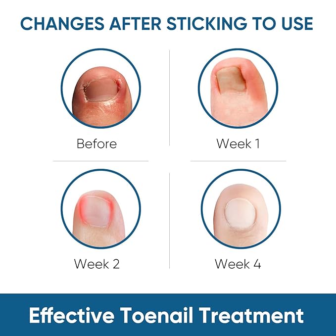 Ingrown Toenail Treatment, 60Pcs Ingrown Toenail Corrector Strips, Ingrown Toenail Removal Kit with File and Lifter, 60Pcs-VivaGrace Women