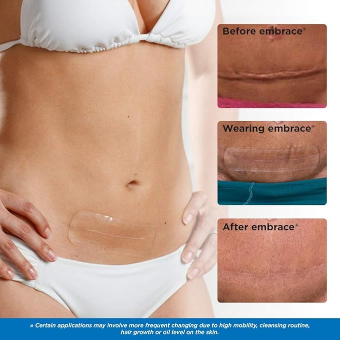 Embrace Active Scar Defense for New Scars, FDA-Cleared Medical-Grade Silicone Scar Sheets for Hypertrophic & Keloid Scar Treatment, 4.7 Inch, Large, 30-Day Supply-VivaGrace Women