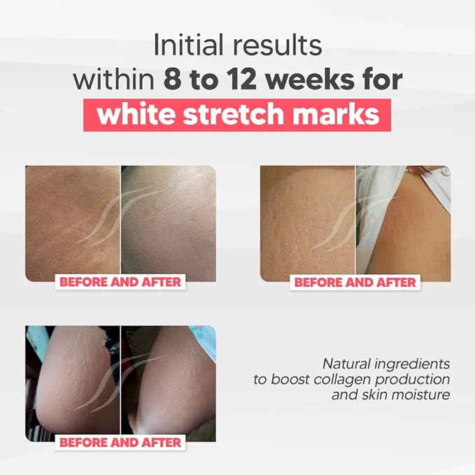 Cicatrissim White Stretch Mark Fade and Removal Cream - Innovative Formula With Pure and Powerful Natural Ingredients From Brazilian Flora - For All Skin Types.-VivaGrace Women