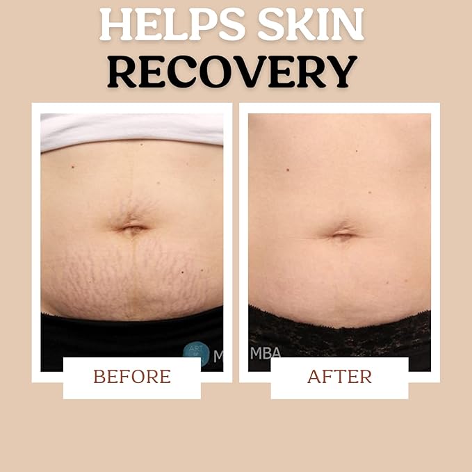 Stretch Mark Cream for Sensitive Skin Plant-Based Long and Short-term Hydration, Increases Skin Elasticity and Firmness (Stretch Mark Cream)-VivaGrace Women