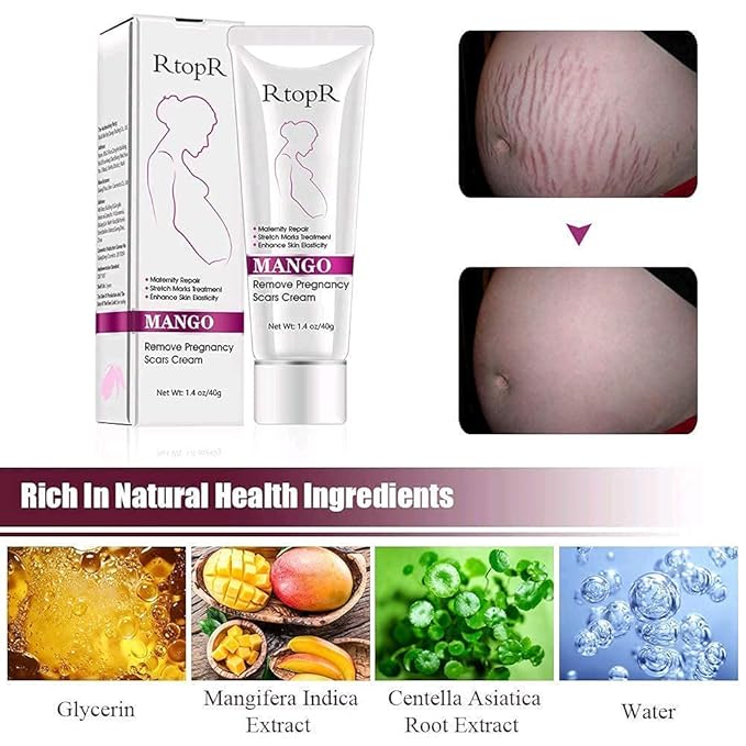 RtopR Mango Stretch Marks and Scar Cream -Stretch Marks and Scar Removal Cream for Pregnancy - Best Body Moisturizer-80g-VivaGrace Women