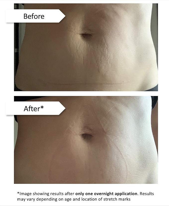 Stretch Mark Eraser | Overnight Stretch Mark Treatment | 1 patch-VivaGrace Women