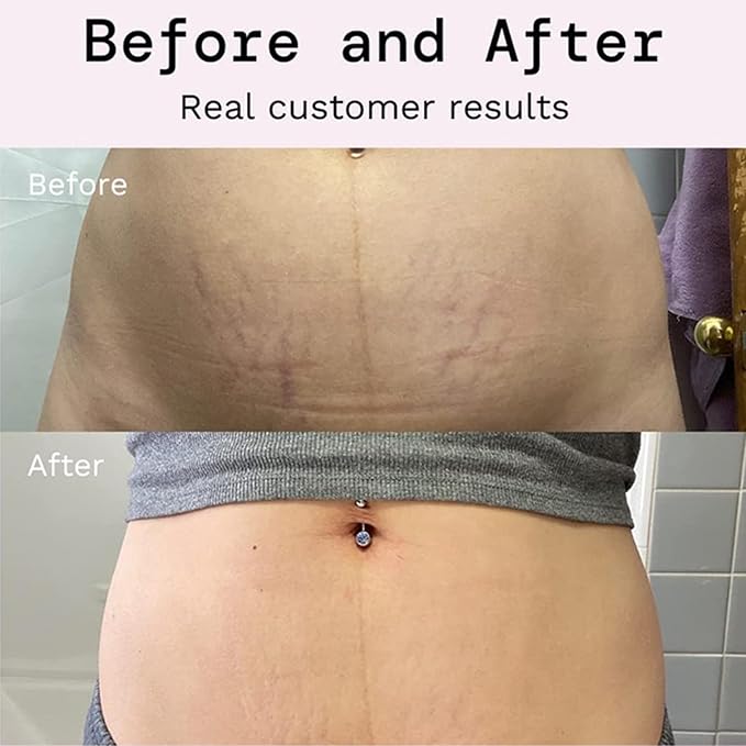 Stretch Mark Prevention Cream for Pregnancy, Stretch Mark Cream Remover, Stretch Mark Lotion for Pregnancy, Tummy Butter for Stretch Marks Pregnancy, Shea Butter Stretch Mark Removal Cream-VivaGrace Women